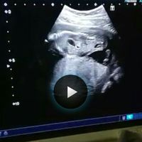 Ayuda con método ramzi: niño o niña? - 2