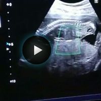 Ayuda con método ramzi: niño o niña? - 3