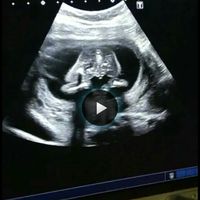 Ayuda con método ramzi: niño o niña? - 4