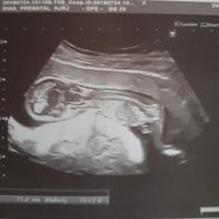 Ayuda con método ramzi: niño o niña? - 1