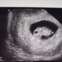 Ayuda con método ramzi: niño o niña? - 2