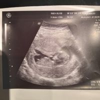 Ayuda con método ramzi: niño o niña? - 1
