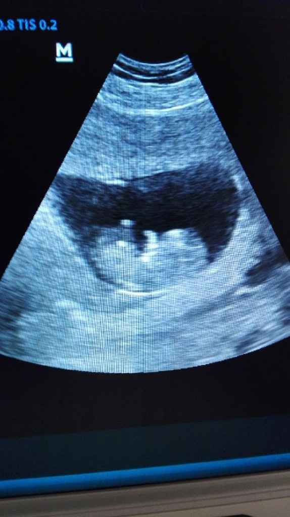 Ayuda con método ramzi: niño o niña? - 1