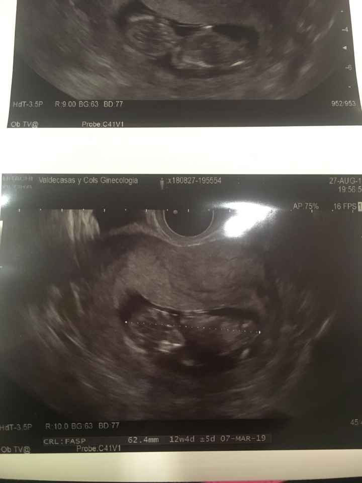 Ayuda con método ramzi: niño o niña? - 2