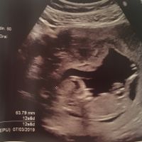Ayuda con método ramzi: niño o niña? - 1