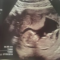 Ayuda con método ramzi: niño o niña? - 2
