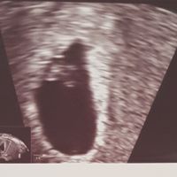 Ayuda con método ramzi: niño o niña? - 1