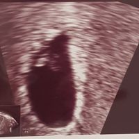 Ayuda con método ramzi: niño o niña? - 2