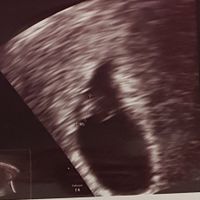 Ayuda con método ramzi: niño o niña? - 3