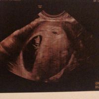 Ayuda con método ramzi: niño o niña? - 1