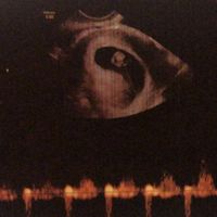 Ayuda con método ramzi: niño o niña? - 2