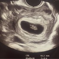 Ayuda con método ramzi: niño o niña? - 1