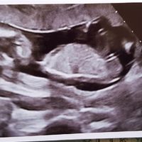 Ayuda con método ramzi: niño o niña? - 1