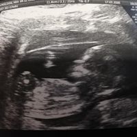 Ayuda con método ramzi: niño o niña? - 1