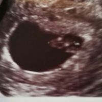 Ayuda con método ramzi: niño o niña? - 2