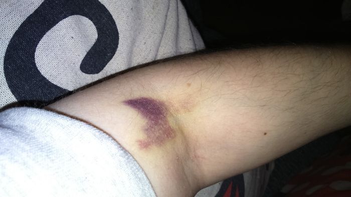 Hematoma