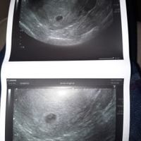 Proceso tratamiento fiv - 1