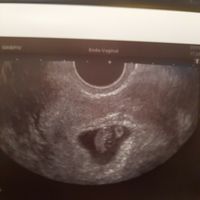 Ayuda con método ramzi: niño o niña? - 1