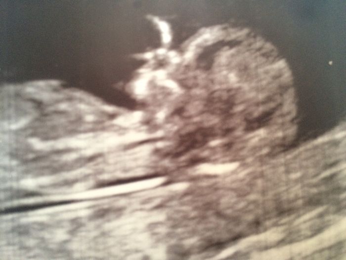 Buscadoras después de uno o varios abortos  - 1