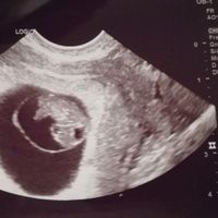 Ayuda con método ramzi: niño o niña? - 1