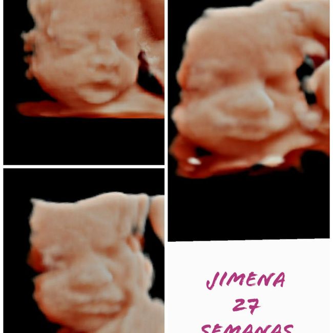 Proceso tratamiento fiv - 1