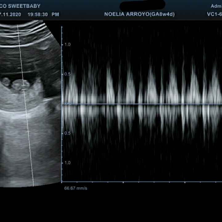 Proceso tratamiento fiv - 1