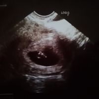 Ayuda con método ramzi: niño o niña? - 1