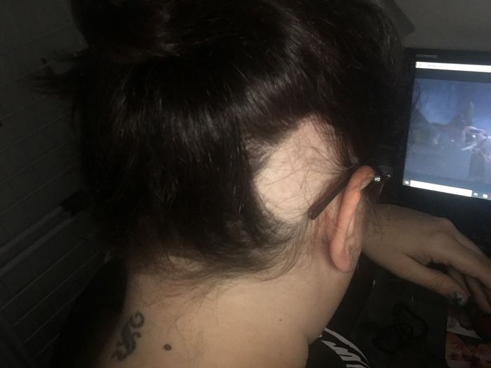 Novia con alopecia areata - 1