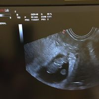 Ayuda con método ramzi: niño o niña? - 1