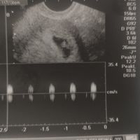 Proceso tratamiento fiv - 1
