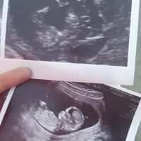Tubérculo genital niño o niña??? - 1