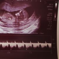 Ayuda con método ramzi: niño o niña? - 1