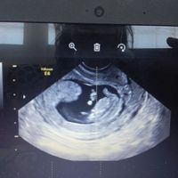 Metodo saad ramzi para saber el sexo del bebe - 1