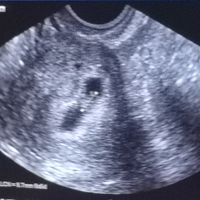 Ayuda con método ramzi: niño o niña? - 2