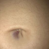 Proceso tratamiento fiv - 1