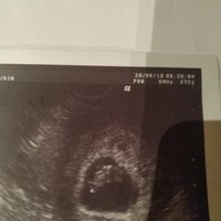 Ayuda con método ramzi: niño o niña? - 1