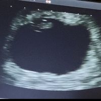 Ayuda con método ramzi: niño o niña? - 1