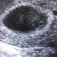 Ayuda con método ramzi: niño o niña? - 1
