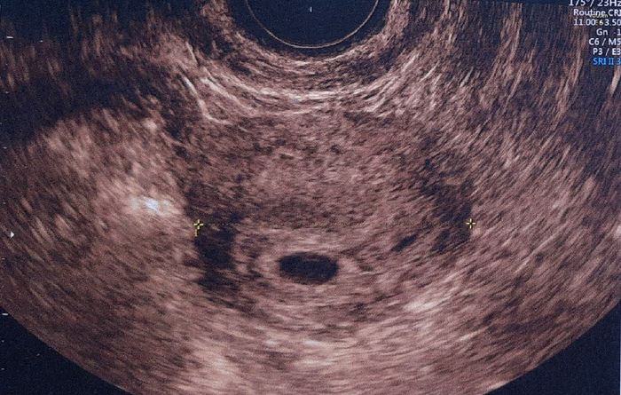 Ayuda con método ramzi: niño o niña? 5