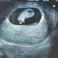 Ayuda con método ramzi: niño o niña? - 1