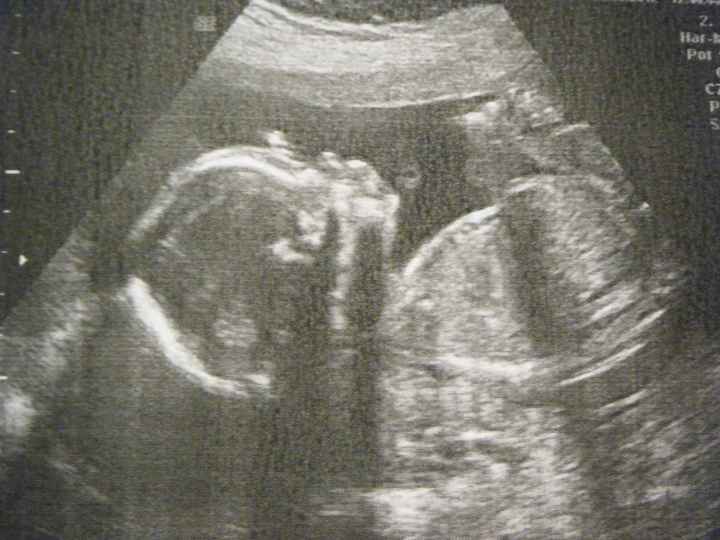 20 semanas + 1 eco