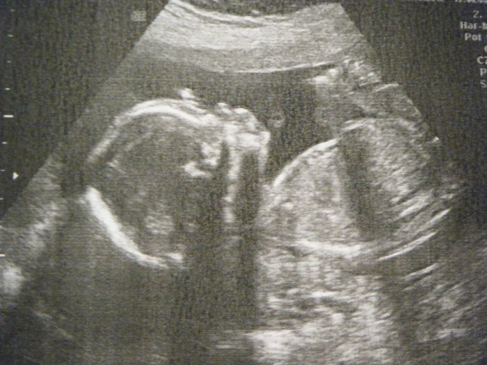 20 semanas + 1 eco