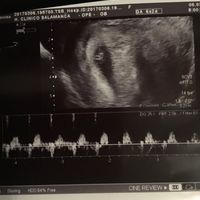 Ayuda con método ramzi: niño o niña? - 1