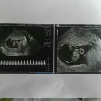 Ayuda con método ramzi: niño o niña? - 1