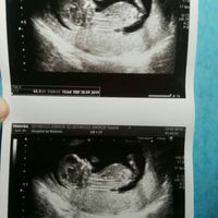 Ayuda con método ramzi: niño o niña? - 1