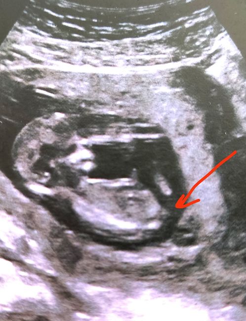Ayuda con método ramzi: niño o niña? - 1