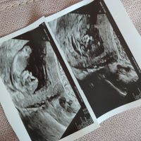 Ayuda con método ramzi: niño o niña? - 1