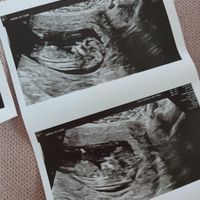 Ayuda con método ramzi: niño o niña? - 2