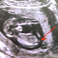 Ayuda con método ramzi: niño o niña? - 1