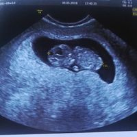 Ayuda con método ramzi: niño o niña? - 1